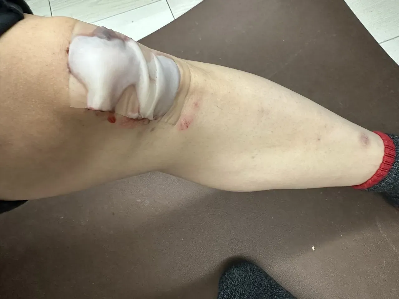 擦り傷に”エアウォール”が良い！キズパワーパッドの1/7ぐらいのコスト - 画像7