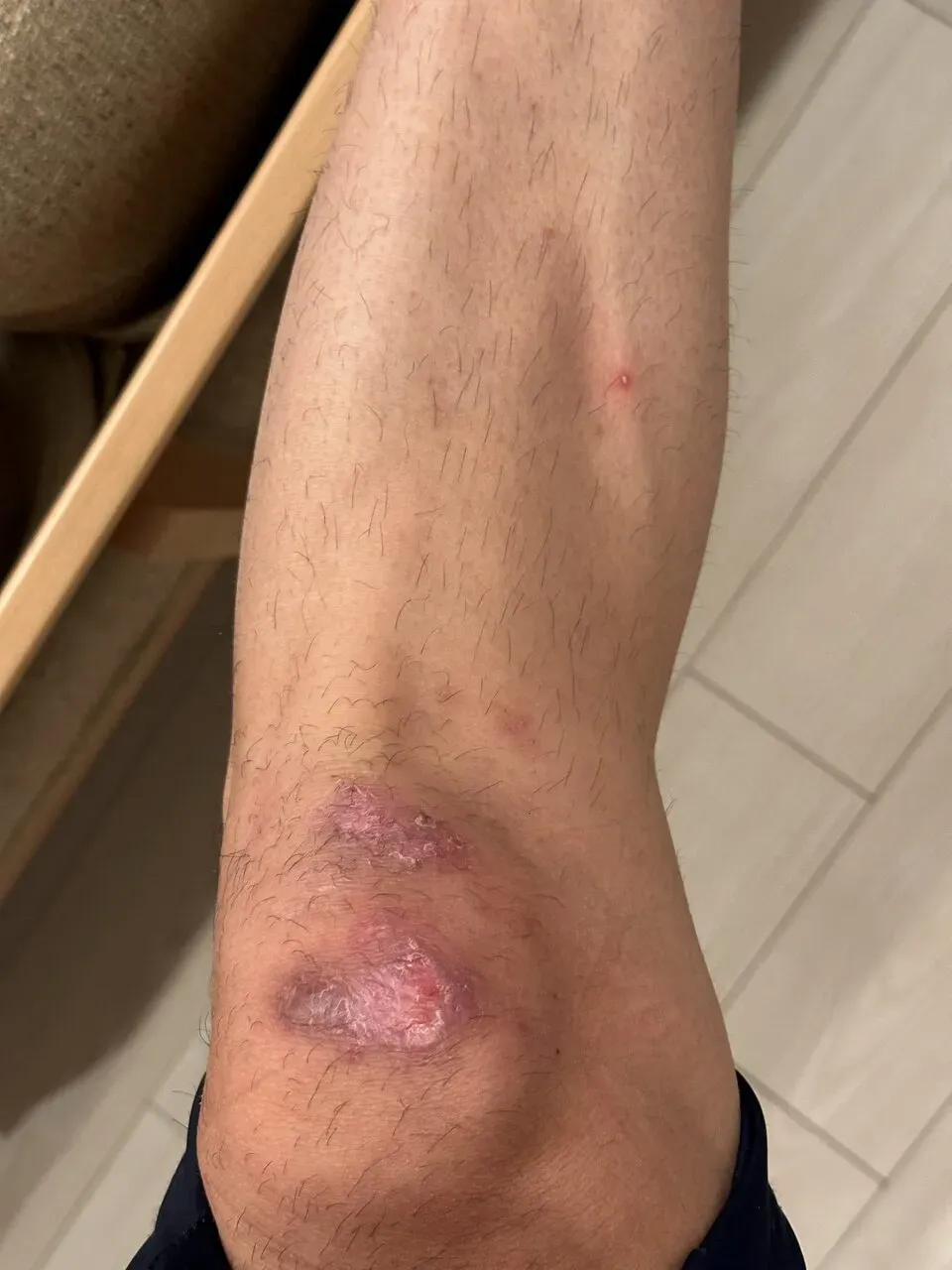 擦り傷に”エアウォール”が良い！キズパワーパッドの1/7ぐらいのコスト - 画像12